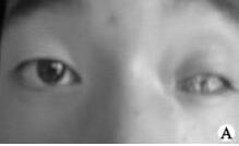 <b>眼球萎缩的患者在佩戴义眼片片时需要注意三点</b>