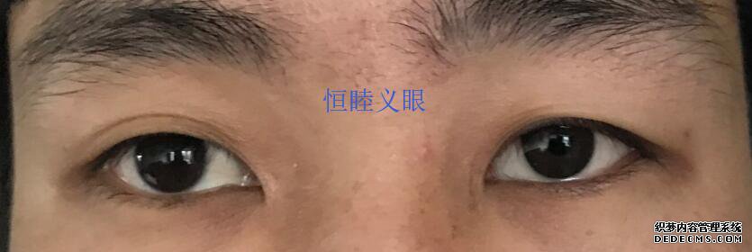 林先生佩戴更换义眼片，保留眼球，眼球萎缩