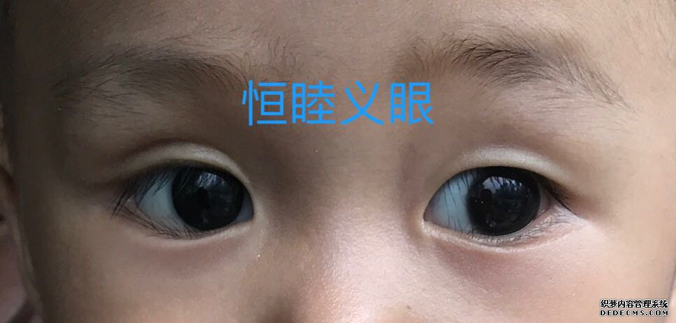 儿童摘除眼球植入义眼台佩戴效果（视网膜母细