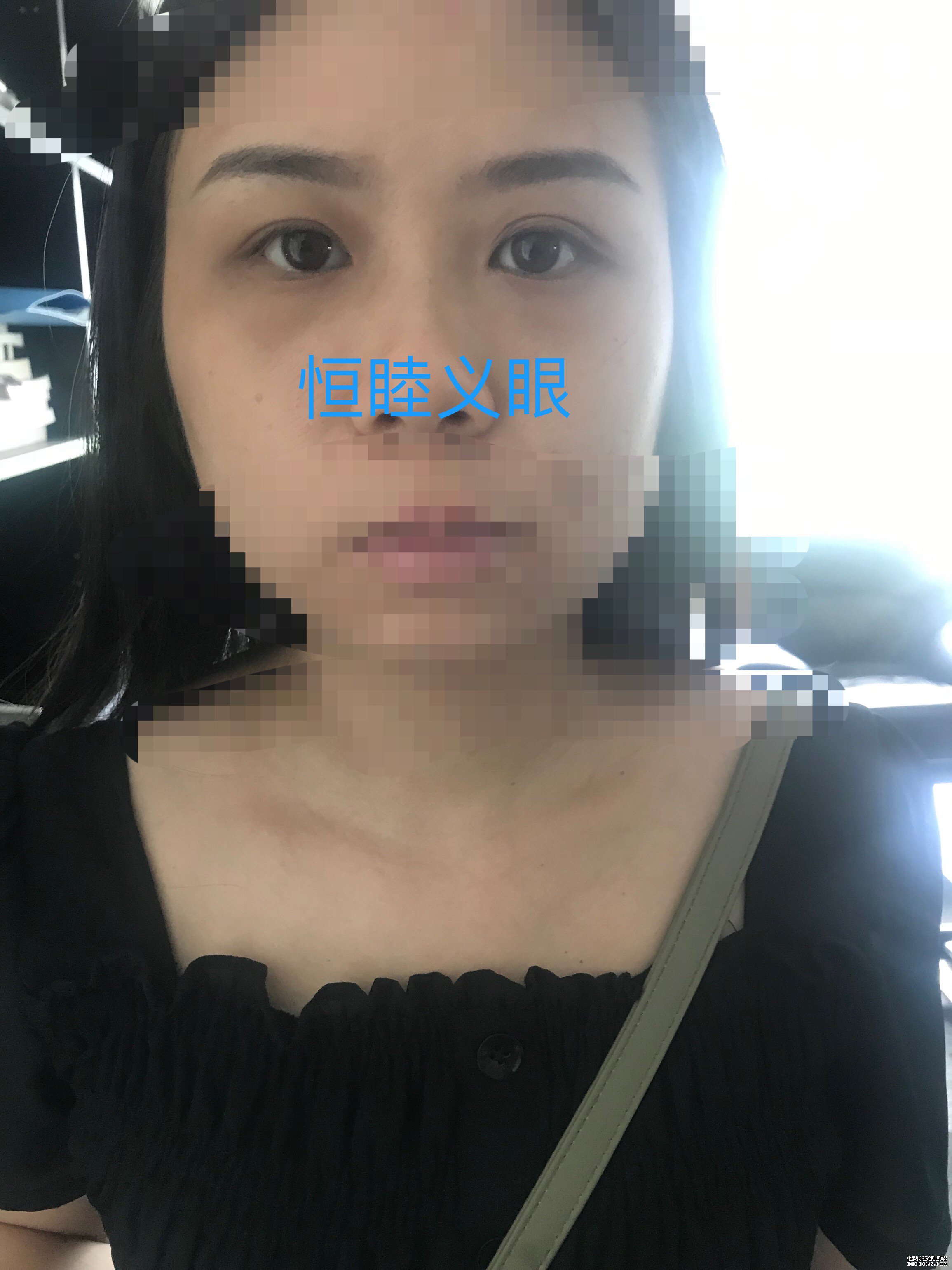 2,眼球萎缩,先天性小眼球,结膜囊狭窄,角膜白斑,无视力需佩戴义眼